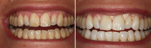 Чищення зубів Air-Flow і ультразукове чистка зубів, професійно виконана в стоматології, забезпечує як лікувальний, так і профілактичний ефект від неї, пишуть стоматологи на   http://stomatologiya